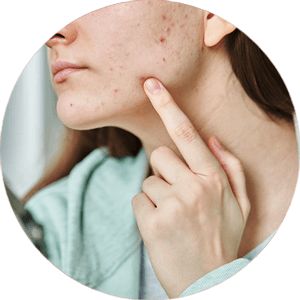 Acneprone Skin
