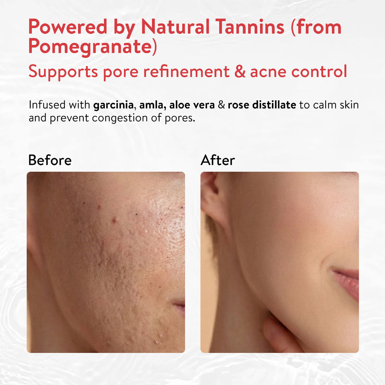 Ayouthveda Acne Enemy Clarifying Facial Toner with Pomegranate, Amla, Aloe Vera & Rose Distillate for Acne & Oil Control | Dermatologically Tested |Suitable for Oily & Acne-Prone Skin | Net Qty – 100 ml