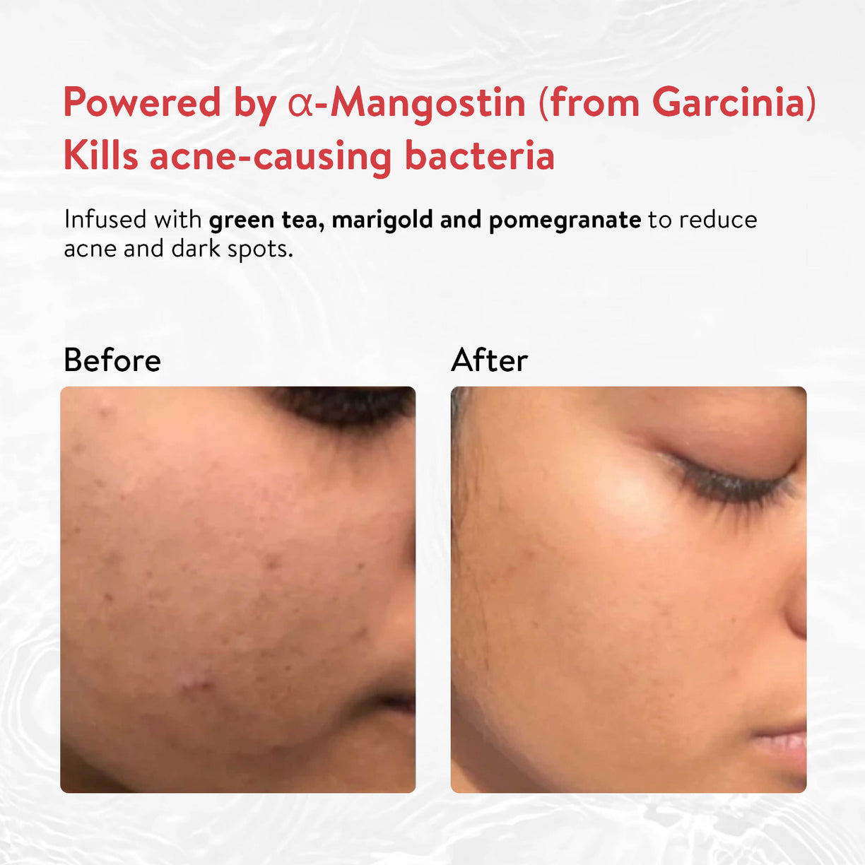 Ayouthveda Acne Enemy Face Wash Gel for Acne & Pimples | Fights Acne-Causing Bacteria & Excess Oil | With Alpha-CURe Complex, Garcinia & Manjistha | Sulfate-Free Gel Cleanser | For Acne-Prone Skin | Net Qty- 100 ml