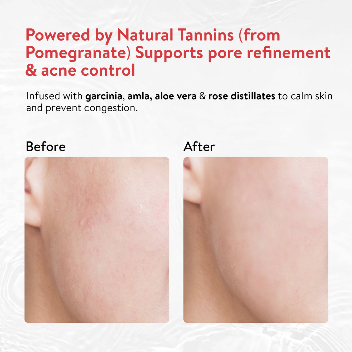 Ayouthveda Acne Enemy Clarifying Facial Toner with Pomegranate, Amla, Aloe Vera & Rose Distillate for Acne & Oil Control | Dermatologically Tested |Suitable for Oily & Acne-Prone Skin | Net Qty – 100 ml